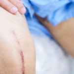 Can I remove Surgical Staples at Home?