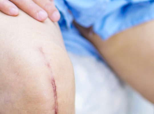 Skin Staple Scar Knee Surgery