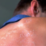 How to Prevent and Treat a Sunburn