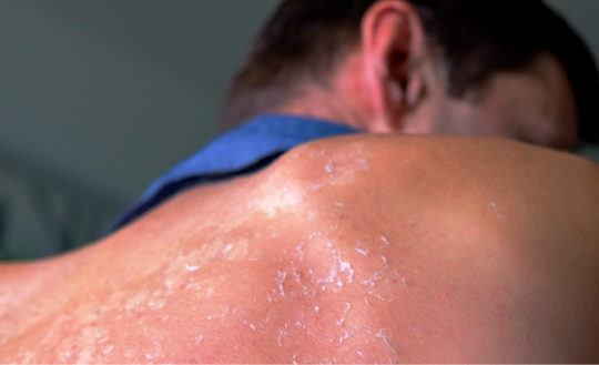 Sunburned Back