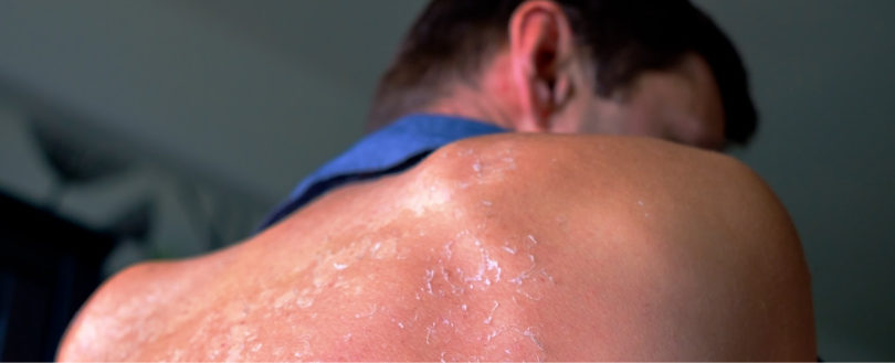 Sunburned Back