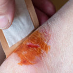 Iodine Wipes vs. Neosporin