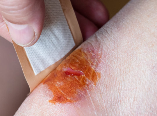 Iodine vs. Neosporin for Wound Cleaning