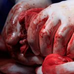 How to Treat and Stop Severe Bleeding