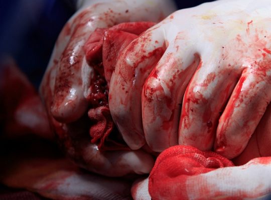 using gloves and gauze to suppress severe bleeding.