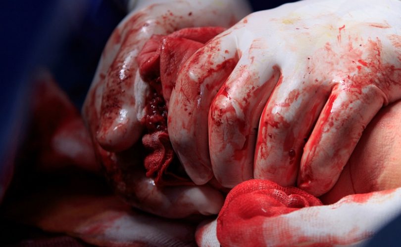 using gloves and gauze to suppress severe bleeding.