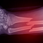 First Aid for a Broken Bone and Fractures