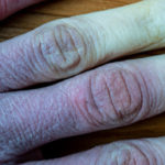 First Aid for Treating Frostbite