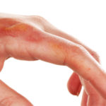 First Aid for Chemical Burns