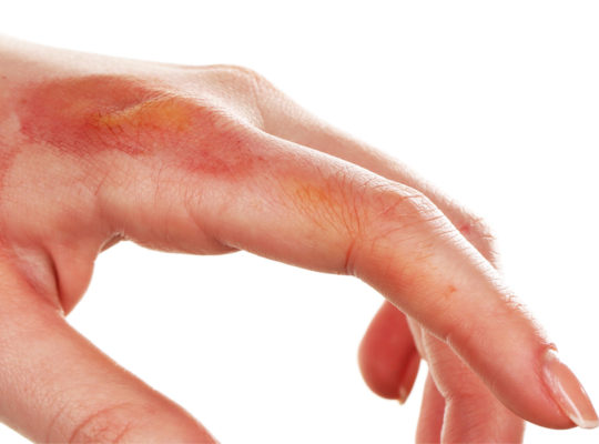 chemical burn on hand
