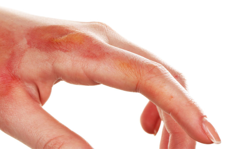 chemical burn on hand chemical burn on hand