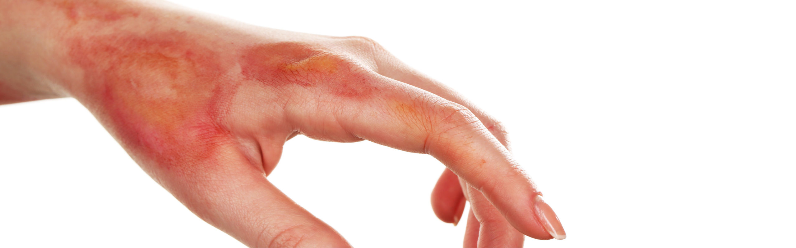 First Aid for Chemical Burns - eFirstAidSupplies Blog