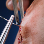 Stitches vs Staples: What Are the Differences?