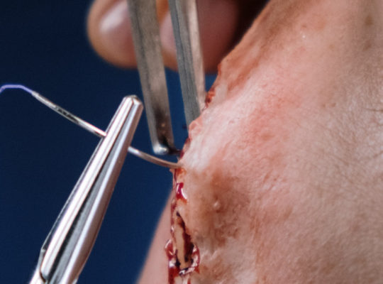 stitching a wound on face