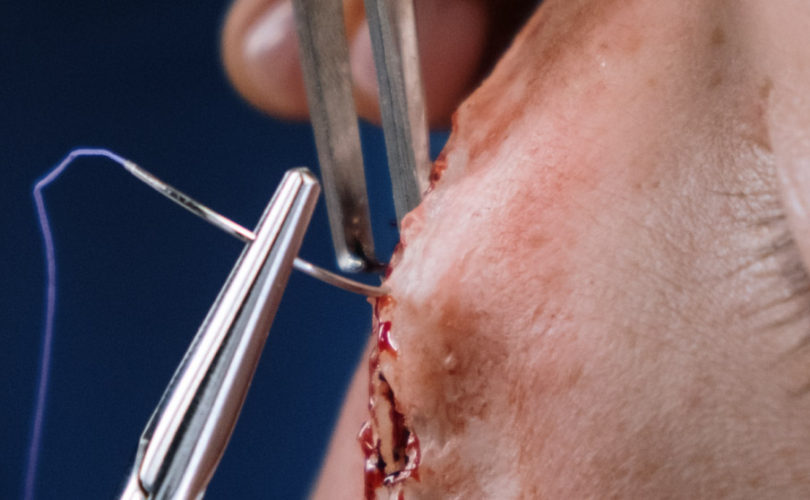 stitching a wound on face