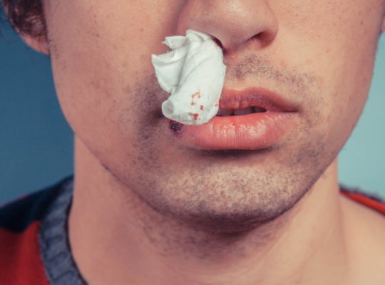 nosebleed care