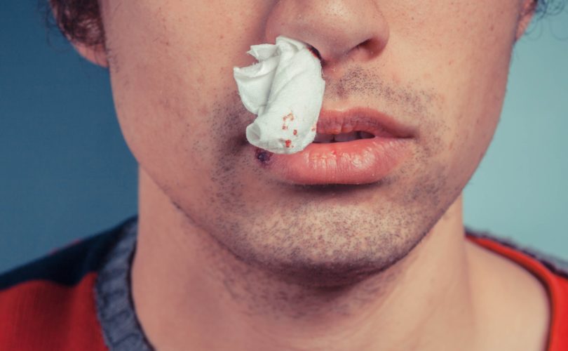nosebleed care
