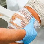 Assessing Wound Drainage In Acute And Chronic Wounds