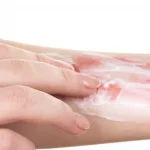 Can You Put Vaseline On Burns?