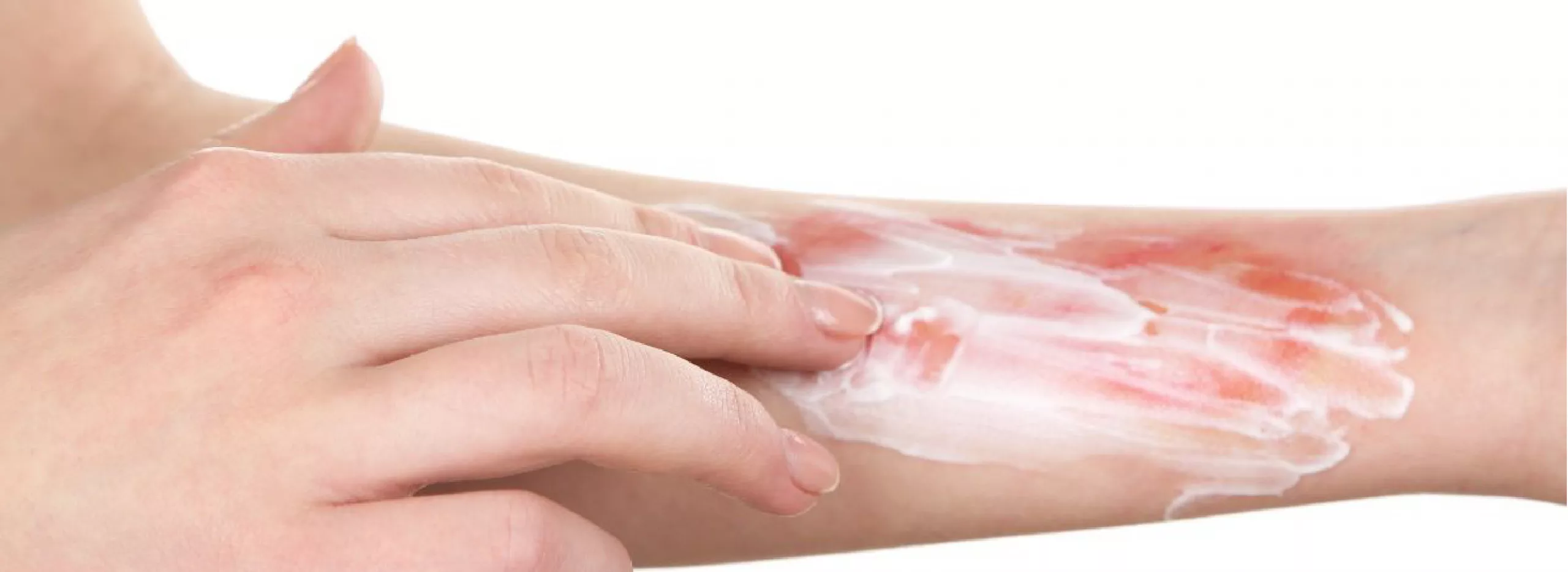applying petroleum jelly to burn wound