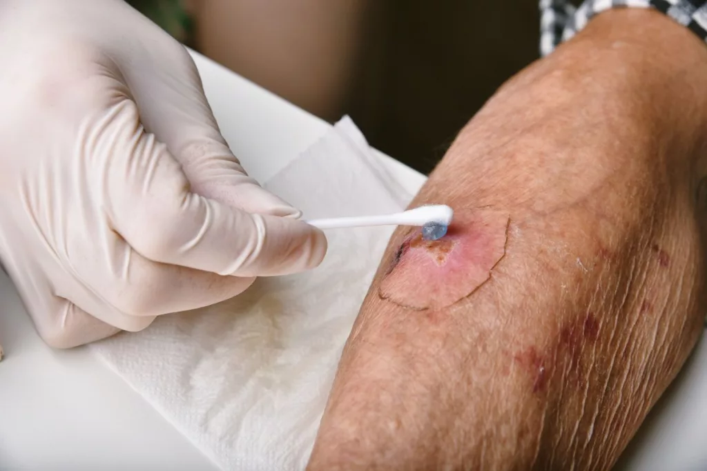 Covered Or Uncovered - Which Is Best For Healing Wounds