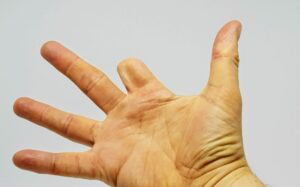 The Fingertip Amputation Healing Process: What to Expect