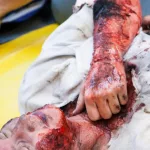 How To Treat Burns With A First Aid Kit [What You Need To Know]