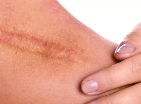 How to make a wound heal faster-01