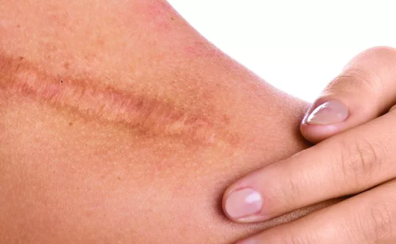 How to make a wound heal faster-01