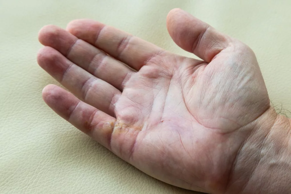 Lumps In Palm Of The Hand