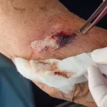 Types of Cuts: Why a Pin-Sized Hole Won’t Stop Bleeding