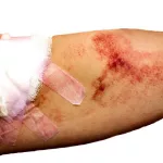 What Happens If Gauze Is Left In A Wound?