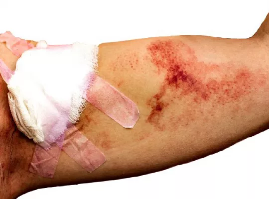Gauze Left in a Wound