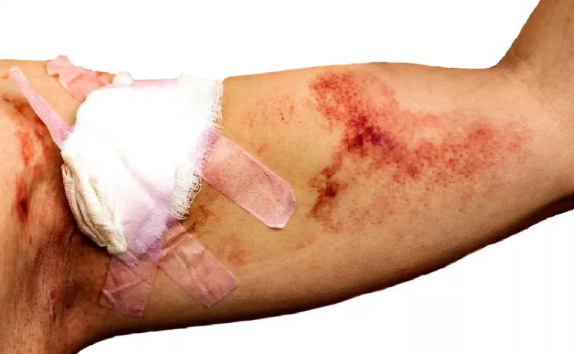 How to treat different types of cuts, grazes, and gashes - We Can