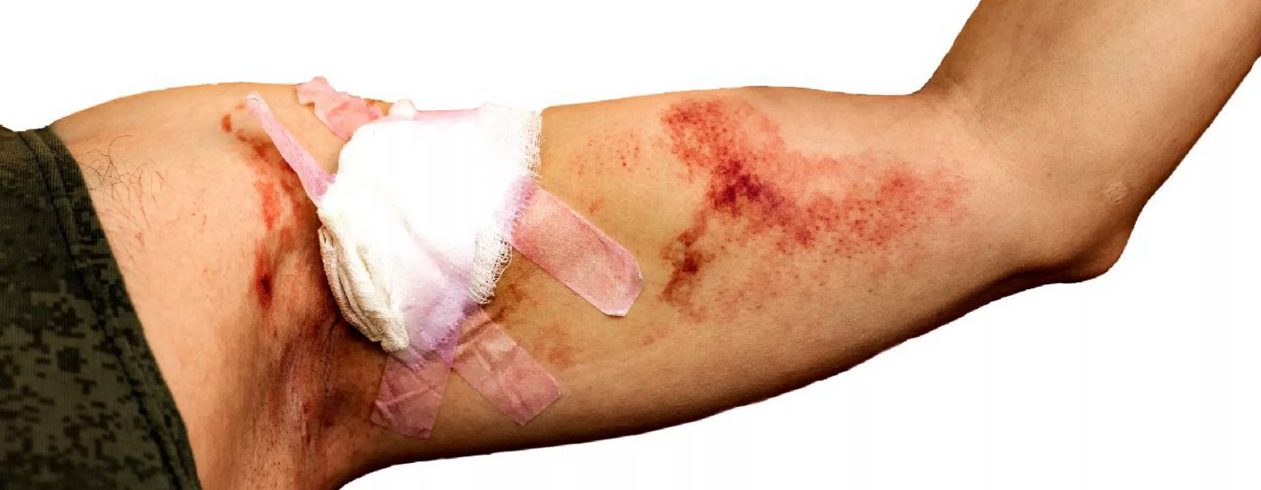 How to tell if a wound is healing or infected