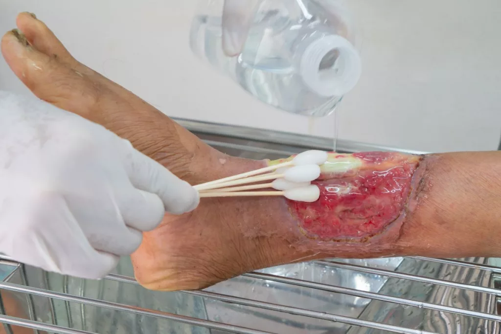 What Happens If Gauze Is Left In A Wound 