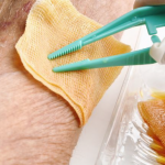 Wound Infection Diagnosis, Treatment And Prevention