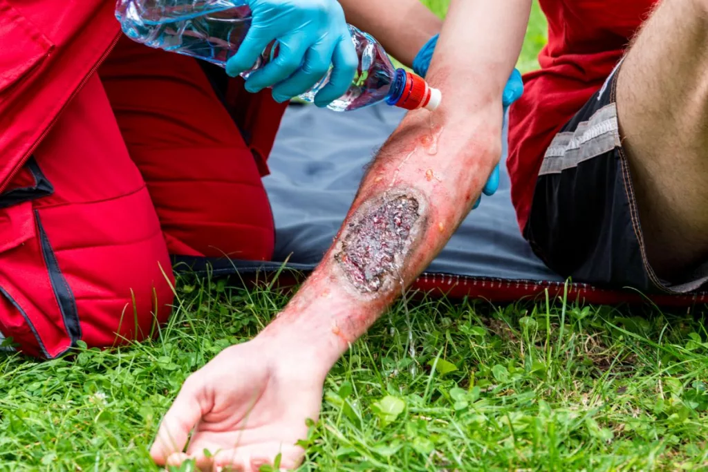 When Should You Use Burn Dressings