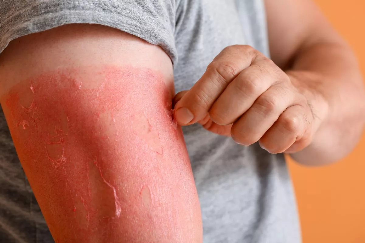 Why Does Sunburned Skin Peel?