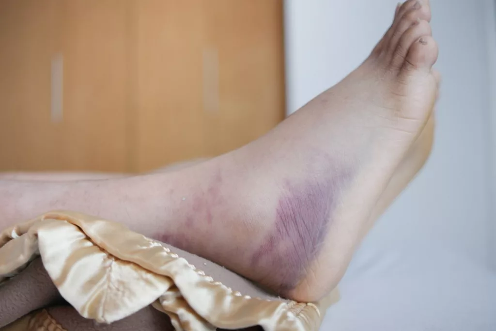 Wound Infection Diagnosis, Treatment and Prevention