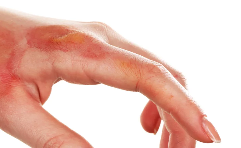 a hand with severe hives