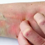 Itchy Red Skin – What Does It Mean? Acne, Rosacea, Eczema, A Rash, Or Something Else Entirely?