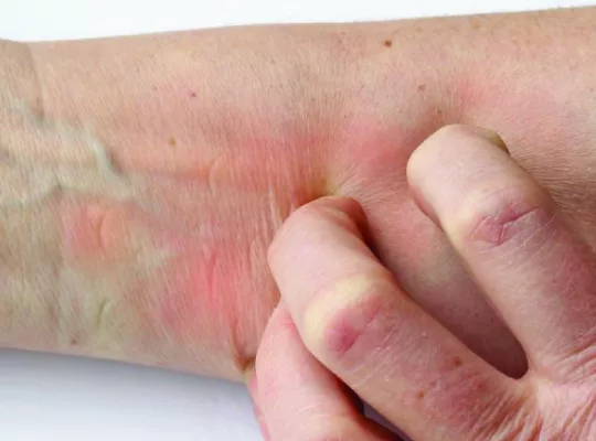 itchy red skin symptom-01