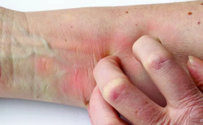 itchy red skin symptom-01