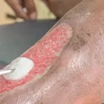 How To Heal An Open Wound Quickly