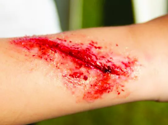 types of open wounds guide-01