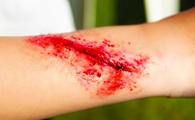 types of open wounds guide-01