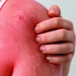 Why Does Sunburned Skin Peel?