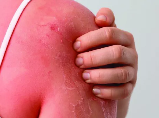 why does sunburnt skin peel-01