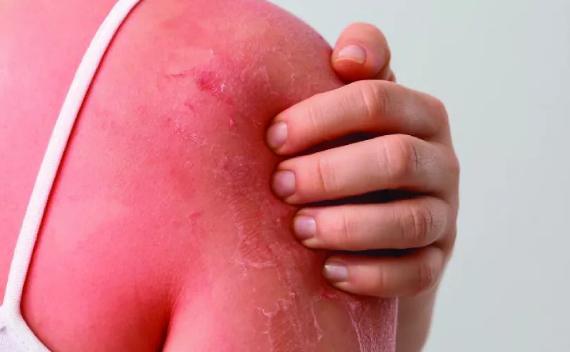 why does sunburnt skin peel-01